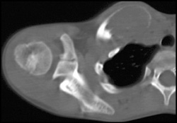 Aneurysmal Bone Cyst (ABC) of Clavicle - CTisus CT Scan