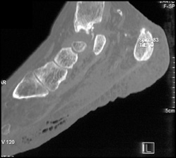 Degenerative Joint Disease (DJD) and Necrotizing Fasciitis - CTisus CT Scan