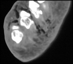 Necrotizing Fasciitis - CTisus CT Scan