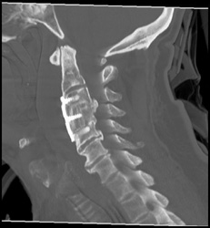 Fused Intervertebral Bodies - CTisus CT Scan