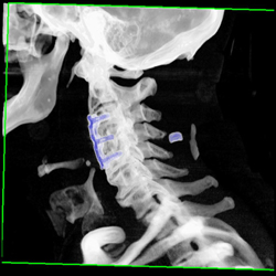 C3 Through C5 Fusion - CTisus CT Scan