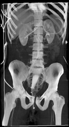 Pelvic Fractures and Hematoma Compress the Bladder - CTisus CT Scan