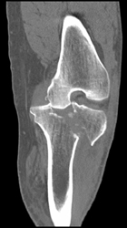 Tibial Plateau Fracture - CTisus CT Scan