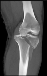 Tibial Plateau Fracture With Impaction - CTisus CT Scan