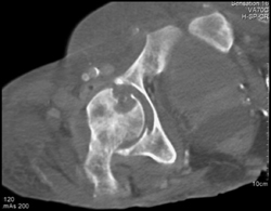 Infected Right Hip Joint With Bone Erosion - CTisus CT Scan