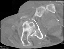 Infected Right Hip Joint - CTisus CT Scan