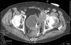 Recurrent Bladder Cancer Invades the Anterior Column and the Symphysis Pubis - CTisus CT Scan