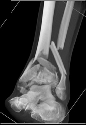 Comminuted Tibial and Fibular Fractures - CTisus CT Scan