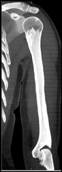 Bone Infarcts - CTisus CT Scan