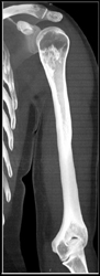 Enchondroma Vs Infarct - CTisus CT Scan