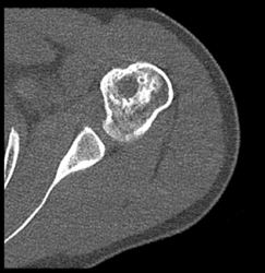 Old Infarct Vs Enchondroma - CTisus CT Scan