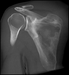 Scapular Fracture - CTisus CT Scan