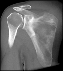 Scapular Fracture - CTisus CT Scan