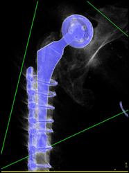 Total Hip Prosthesis - CTisus CT Scan