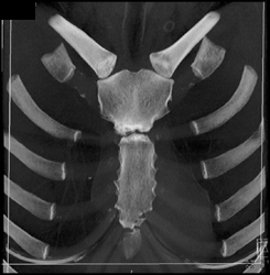 Minimal Imflammation Manubrial-body Joint Space - CTisus CT Scan