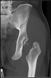 Acetabular Fracture - CTisus CT Scan