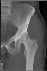 Acetabular Fracture - CTisus CT Scan