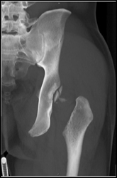 Acetabular Fracture - CTisus CT Scan