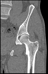 Acetabular Fracture - CTisus CT Scan