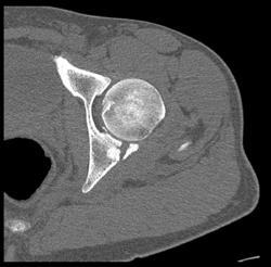 Acetabular Fracture - CTisus CT Scan