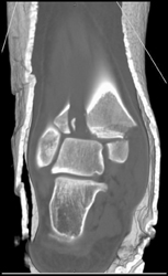 Fracture/ Dislocation - CTisus CT Scan