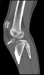 Avulsion of Tibial Plateau - CTisus CT Scan