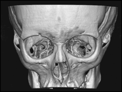 Orbits With Opaque and Transparent VRT - CTisus CT Scan