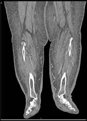 Cellulitis - CTisus CT Scan