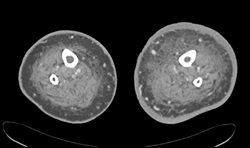 Cellulitis - CTisus CT Scan