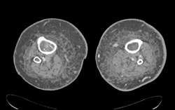 Cellulitis - CTisus CT Scan