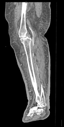 Cellulitis - CTisus CT Scan