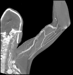 Av Shunt in Dialysis Patient - CTisus CT Scan