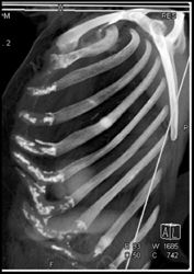 Stress Fracture Rib - CTisus CT Scan