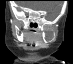 Eosinophilic Granuloma of the Mandible - CTisus CT Scan