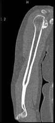 Exostosis - CTisus CT Scan