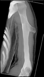 Exostosis - CTisus CT Scan