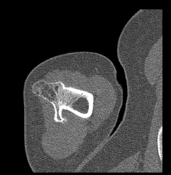 Exostosis - CTisus CT Scan