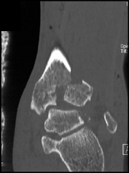 Tibial Fracture With Communition - CTisus CT Scan