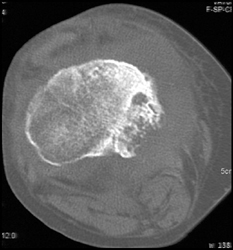 Osteomyelitis - CTisus CT Scan