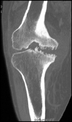 Osteomyelitis - CTisus CT Scan