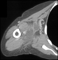 Abscess - CTisus CT Scan