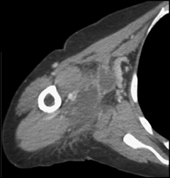 Abscess - CTisus CT Scan