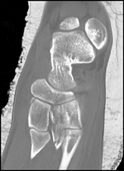 Tarsal and Metatarsal Fracture - CTisus CT Scan