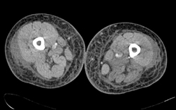 Cellulitis - CTisus CT Scan