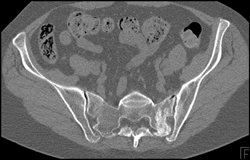 Stress Fracture Sacrum - CTisus CT Scan