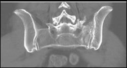 Stress Fracture Sacrum - CTisus CT Scan