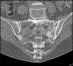 Stress Fracture Sacrum - CTisus CT Scan