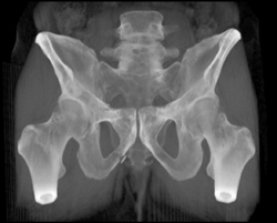 Acetabular Fracture - CTisus CT Scan