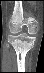 Non Ossifying Fibroma - CTisus CT Scan