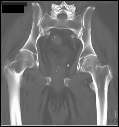 Impacted Left Femur Fracture - CTisus CT Scan